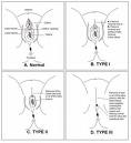 Female Circumcision